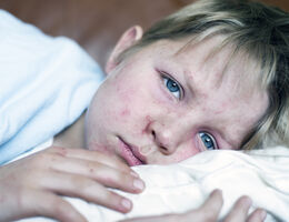 A child in bed with a measles rash visible on his face and hands.
